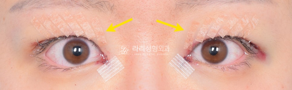 스플린트.jpg