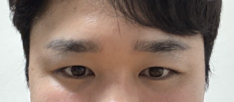 수술후_1달.jpg
