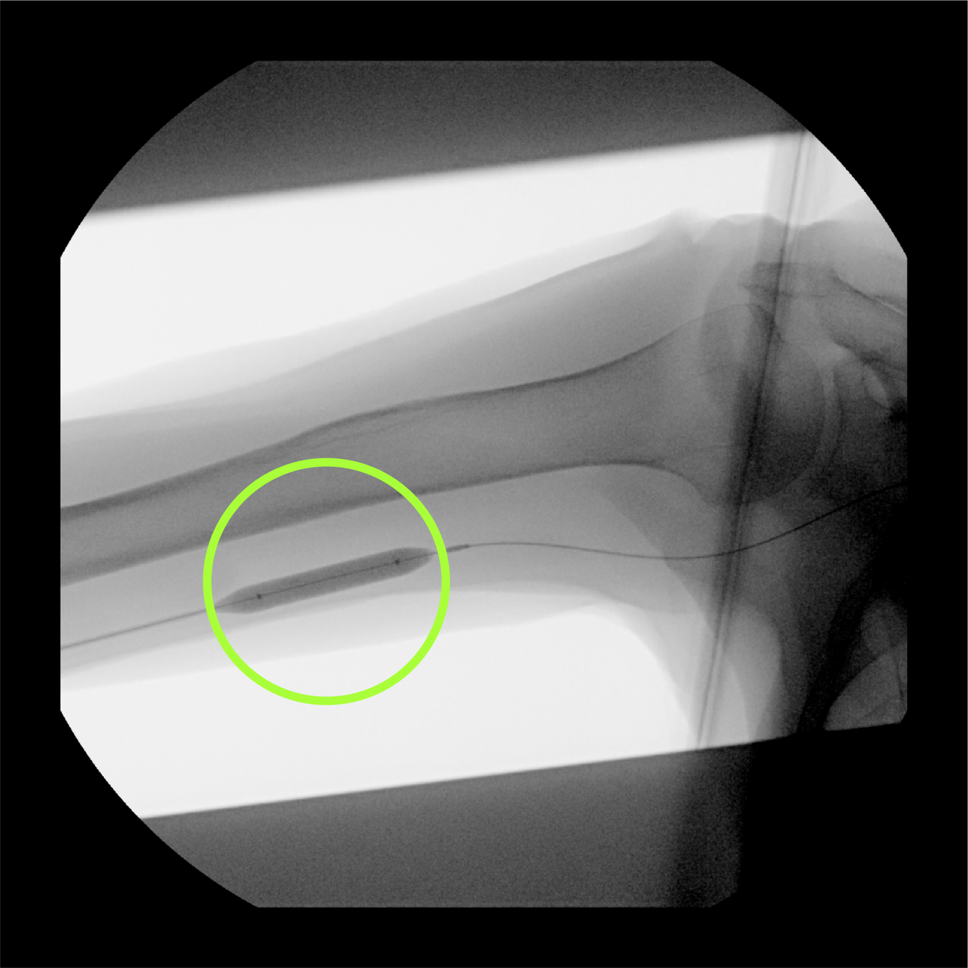 풍선 삽입 과정의 모습