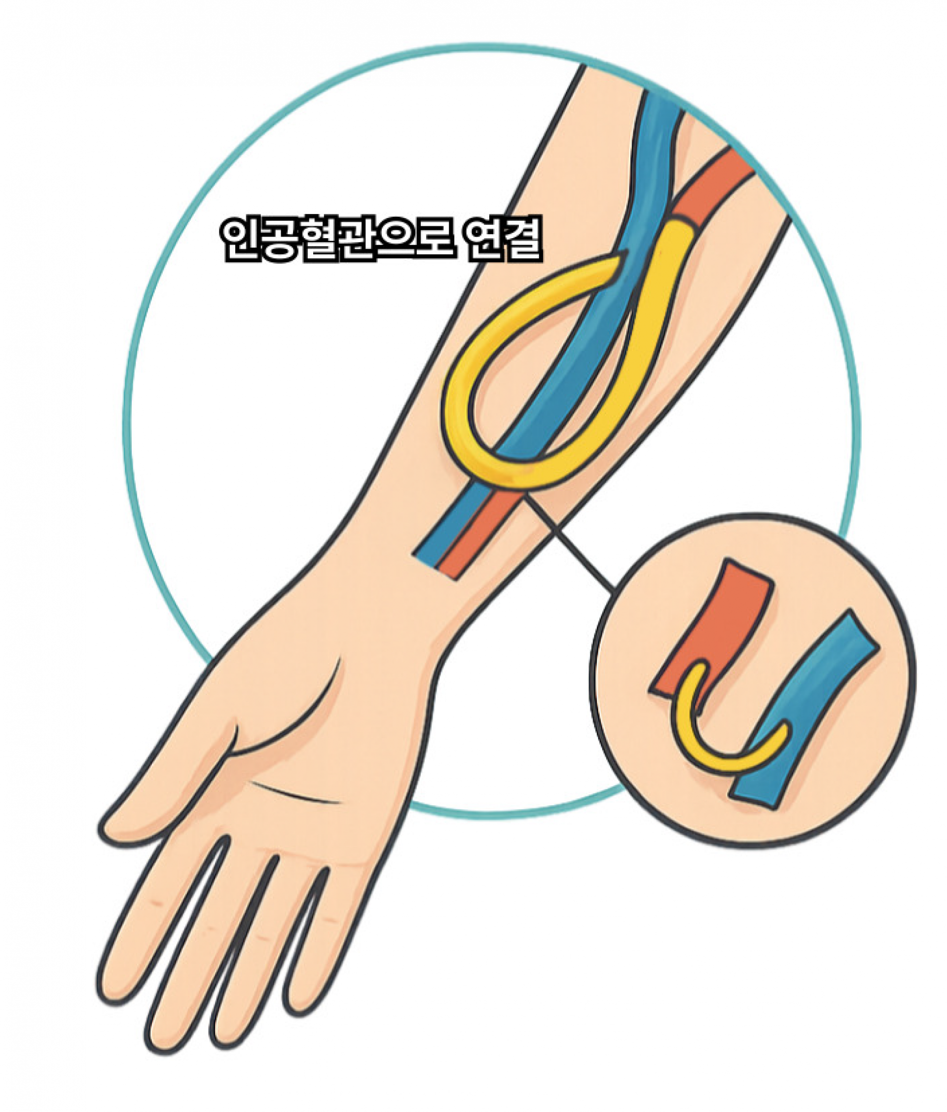 인조혈관조성술