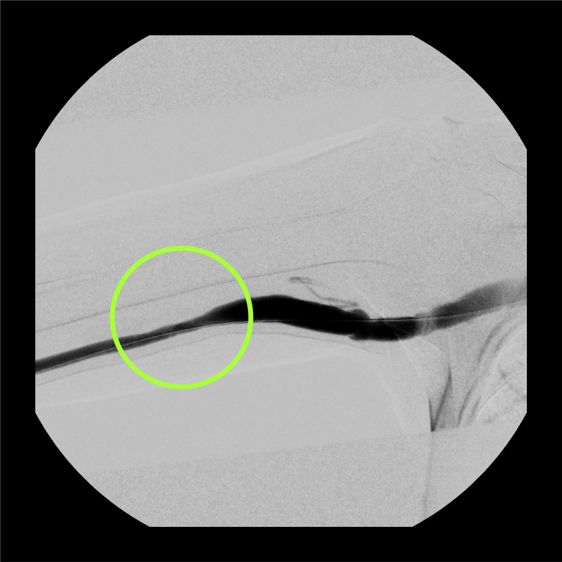 풍선 시술 후의 모습