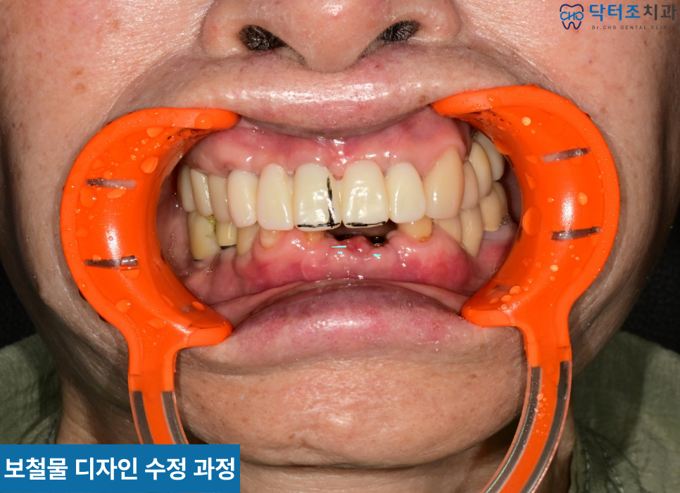 앞니보철사진