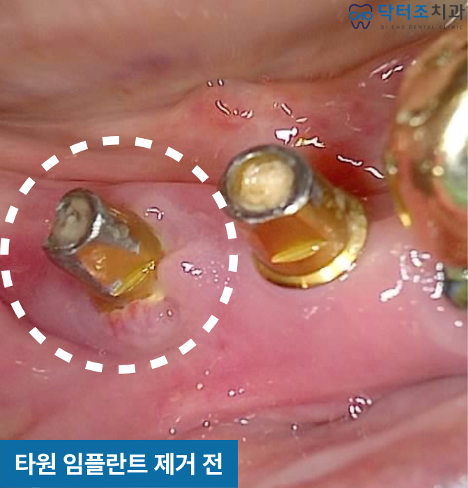 다른병원임플란트