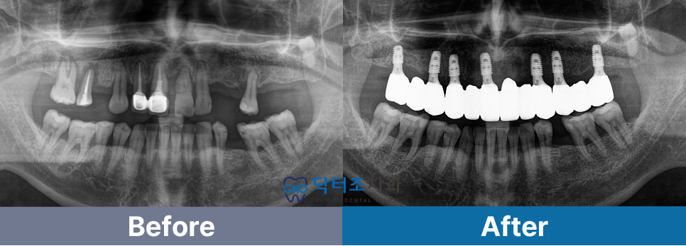 무치악임플란트전후