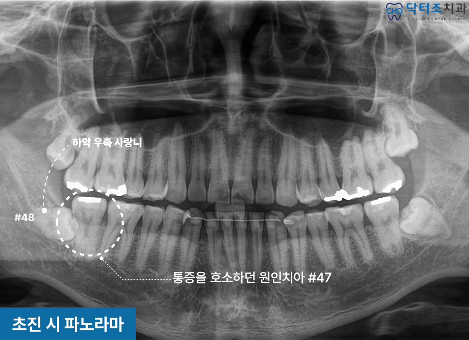 치아균열파노라마