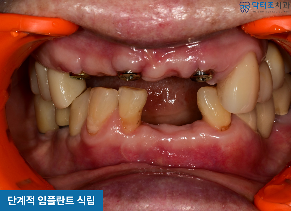 앞니임플란트