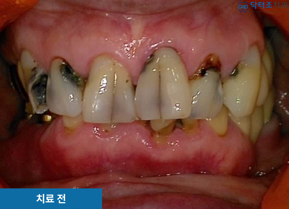 앞니발치