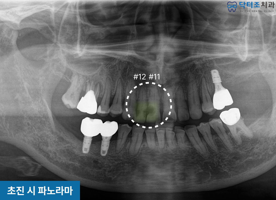 썩은앞니
