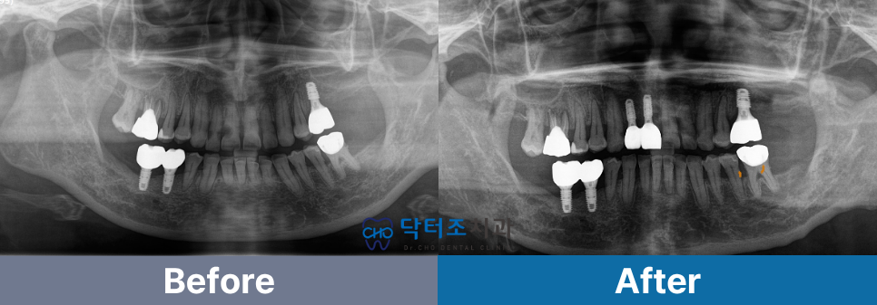 앞니임플란트전후