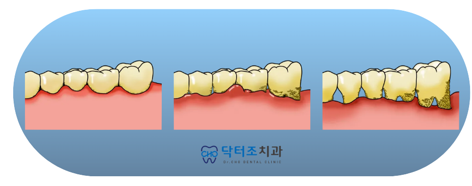 잇몸병스케일링