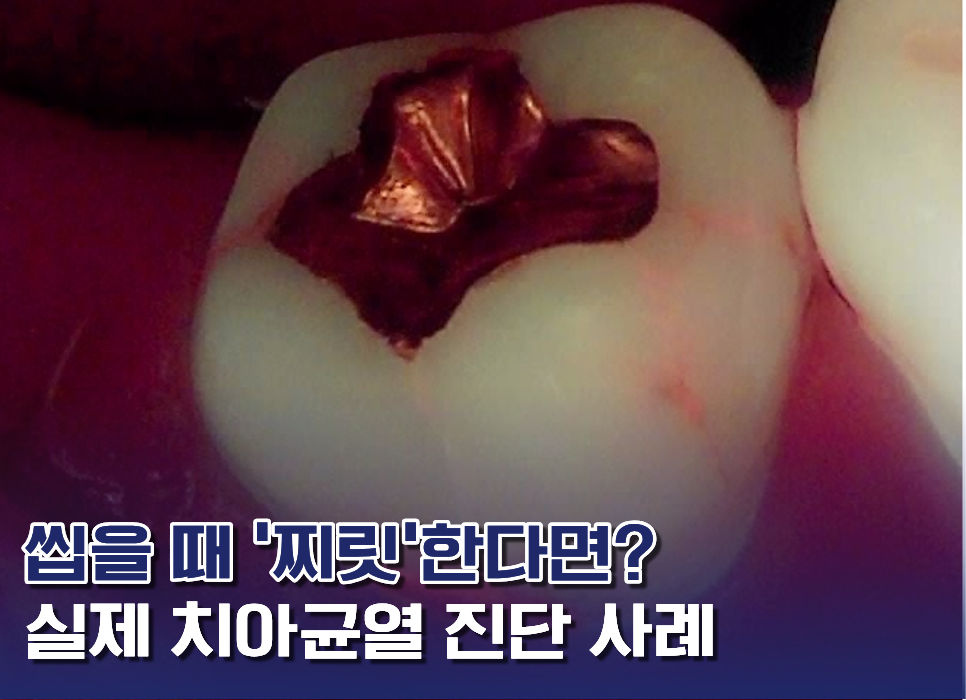 치아균열