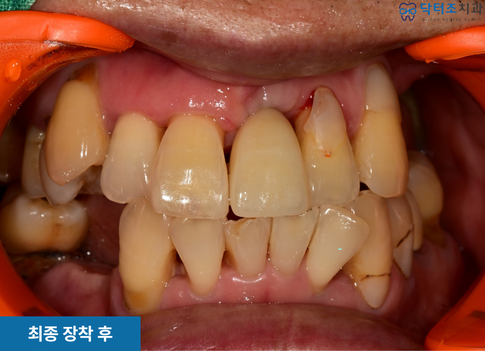 앞니부러짐보철