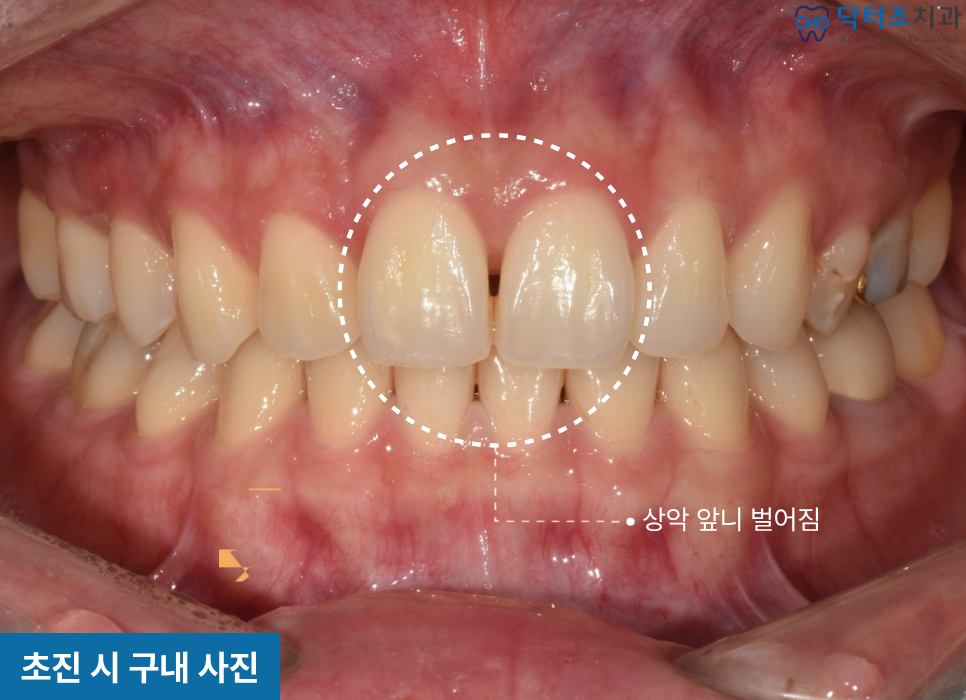 앞니 벌어짐 교정전