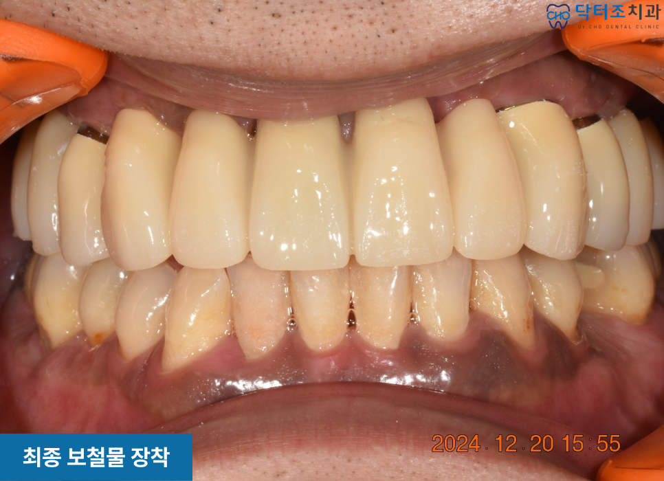 무치악임플란트보철