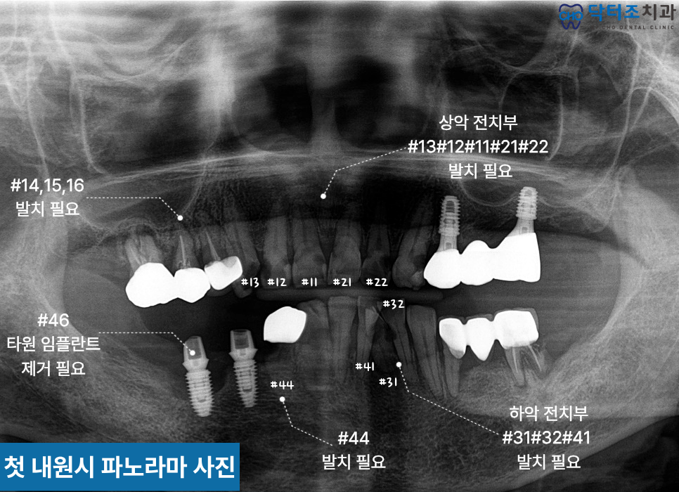 전체임플란트