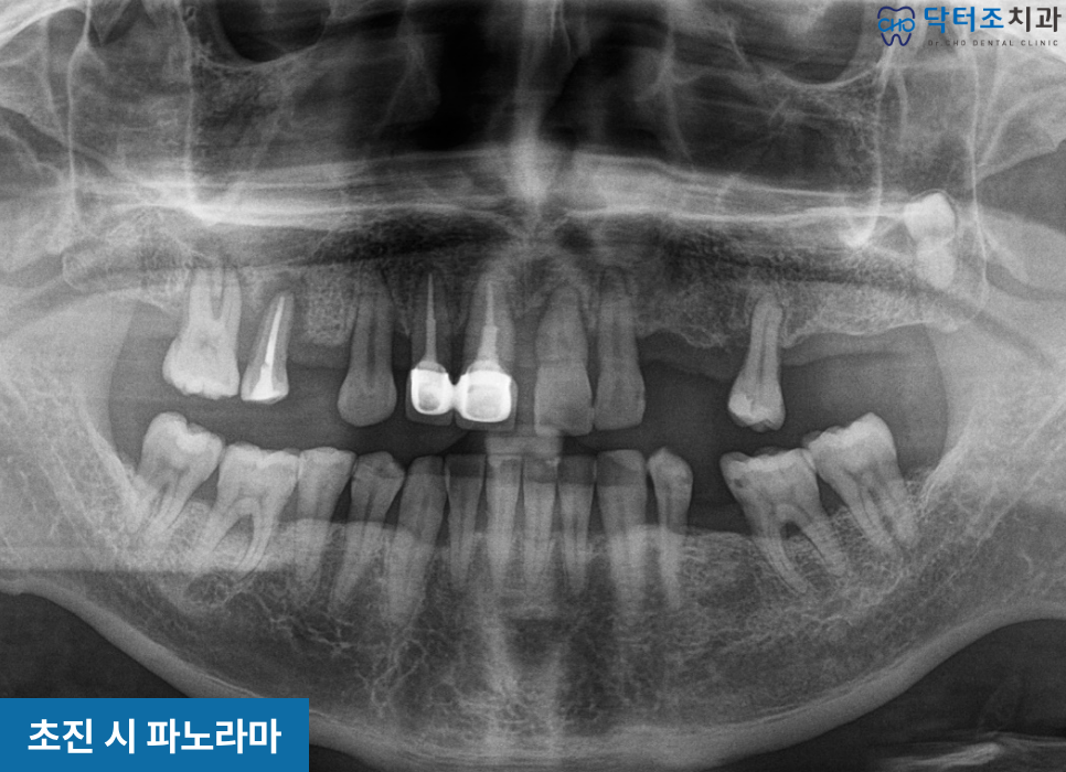 치주염 환자의 파노라마
