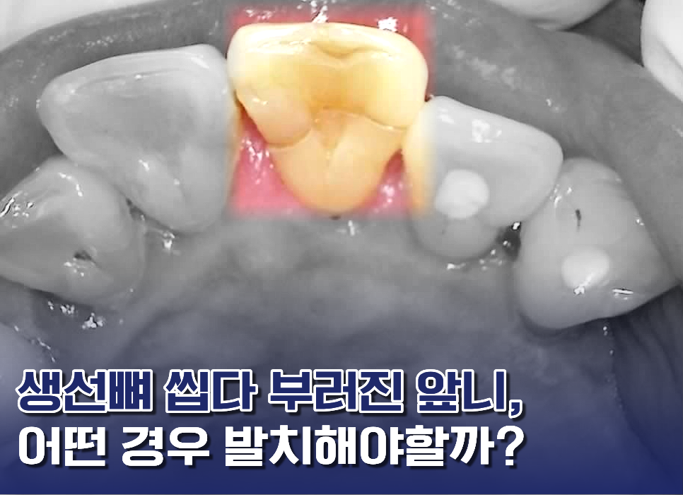 앞니발치임플란트-기훈칼럼.png