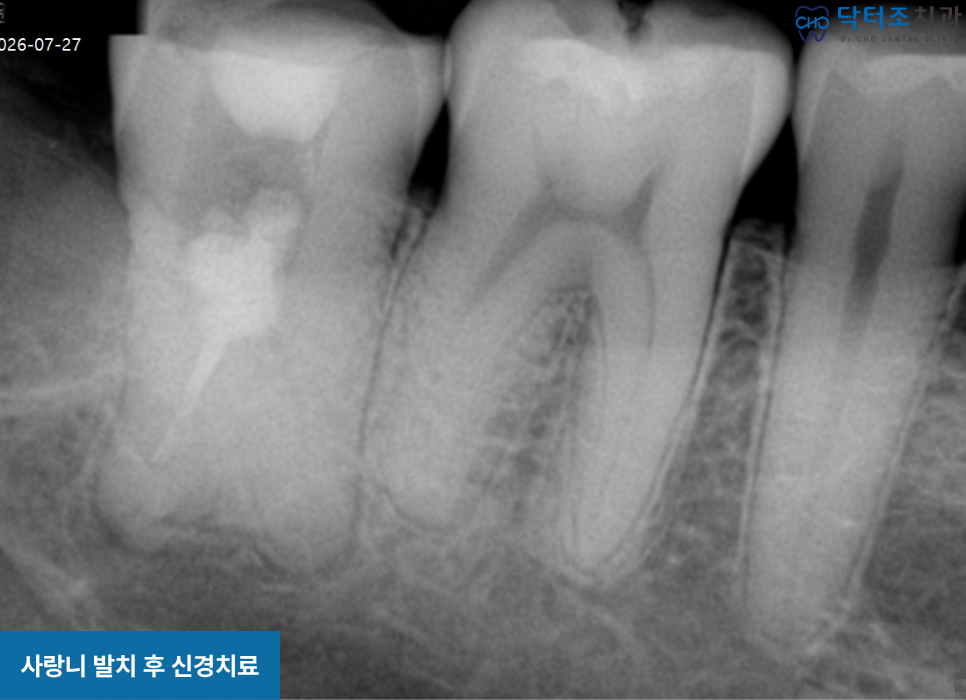 치아균열치료