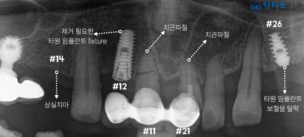임플란트탈락