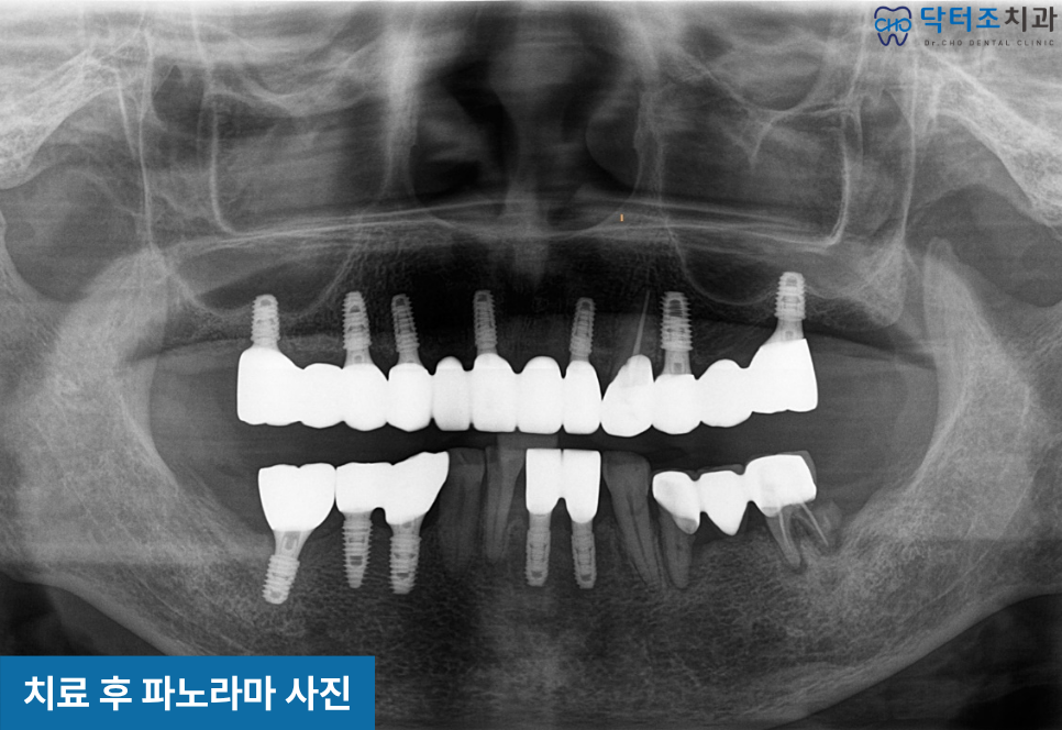 임플란트완성