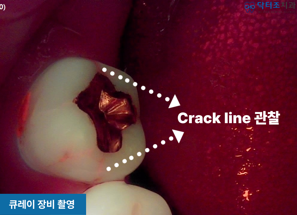 치아균열