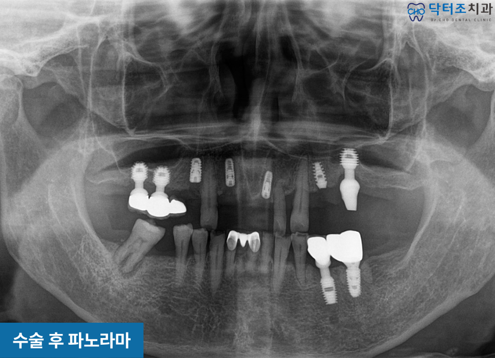 임플란트재수술
