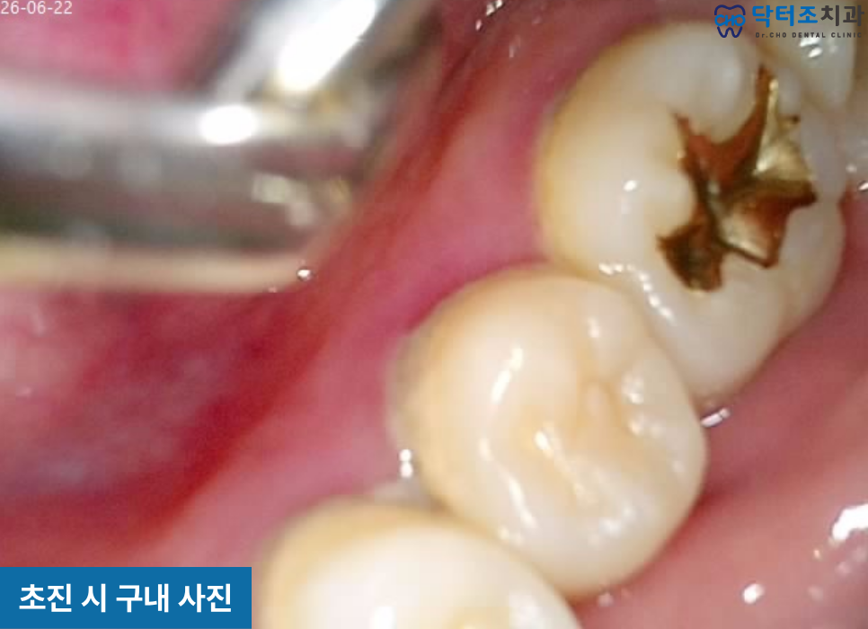 50대잇몸치료