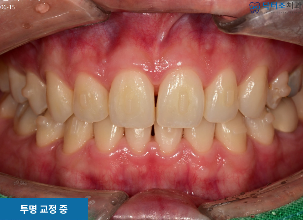 임산부 투명교정사례