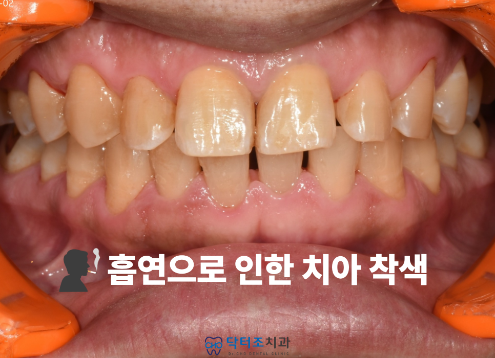 흡연치아
