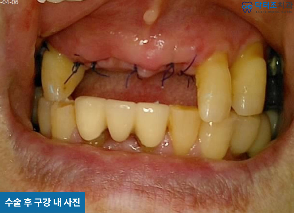 임플란트수술
