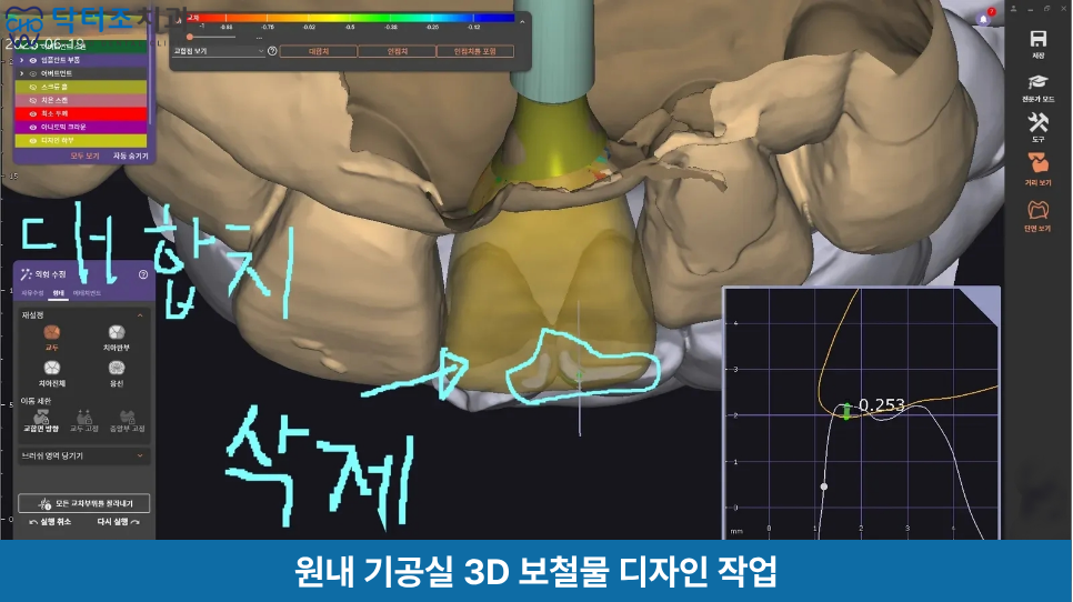 앞니보철