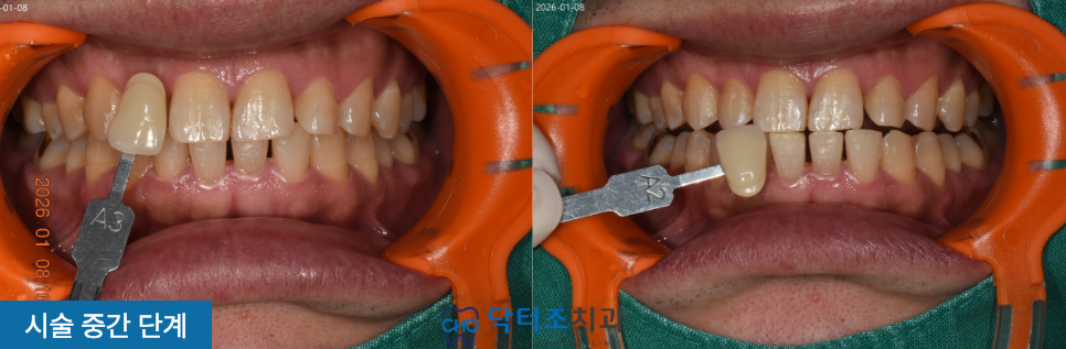 자가치아미백과정