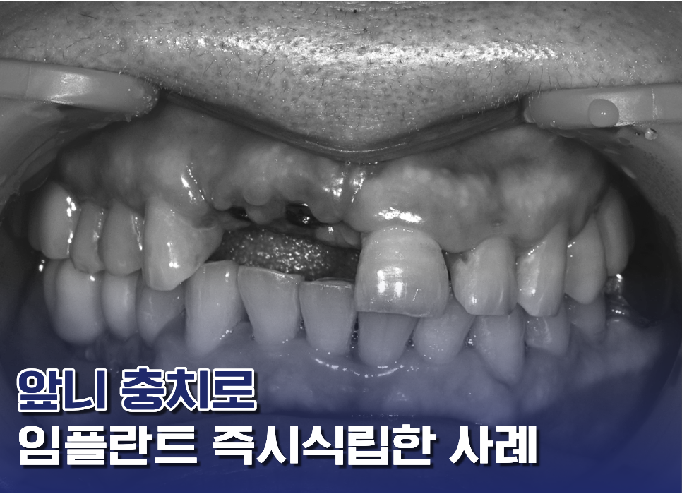 앞니썩음