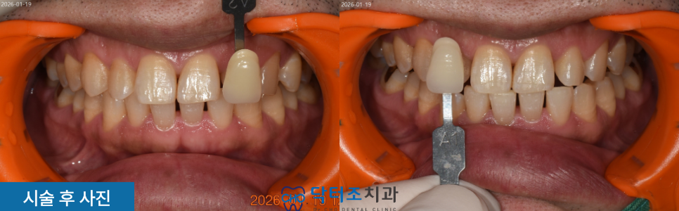 자가미백후