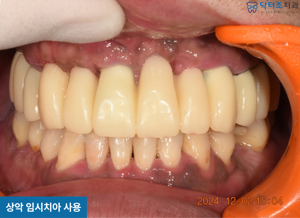 무치악환자의 임플란트 임시치아