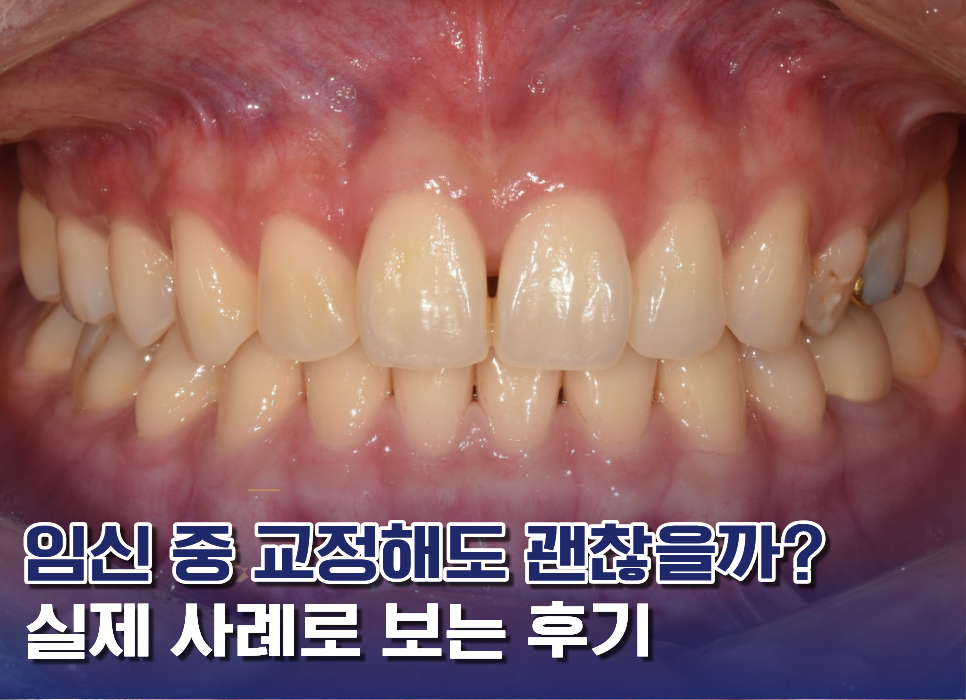 임신중 교정 썸네일