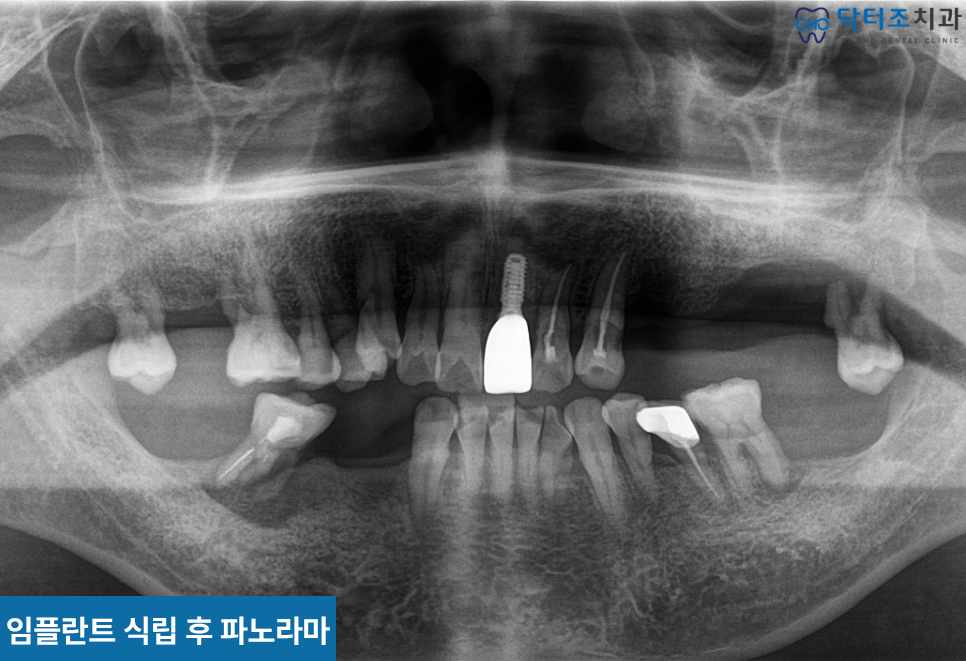 앞니임플란트파노라마