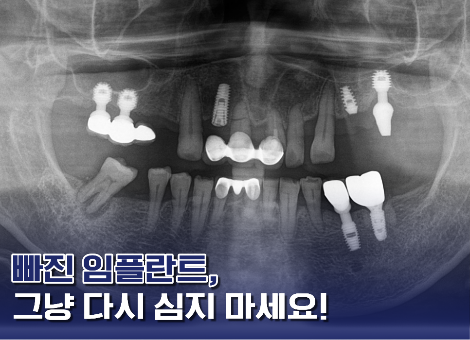 임플란트빠지면