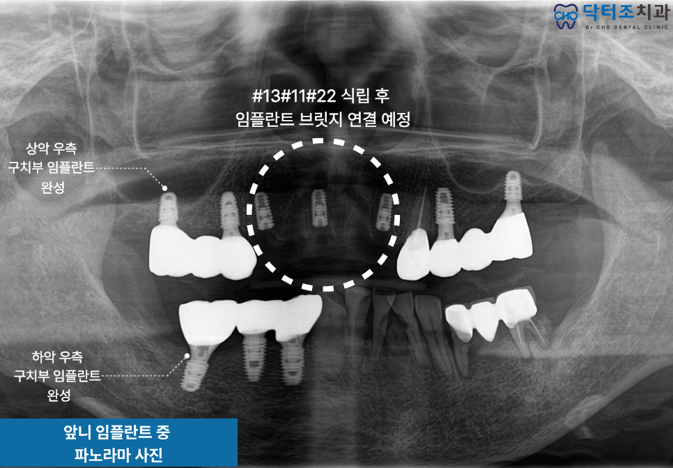 전악임플란트