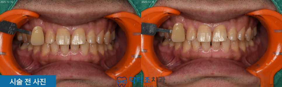 자가치아미백전