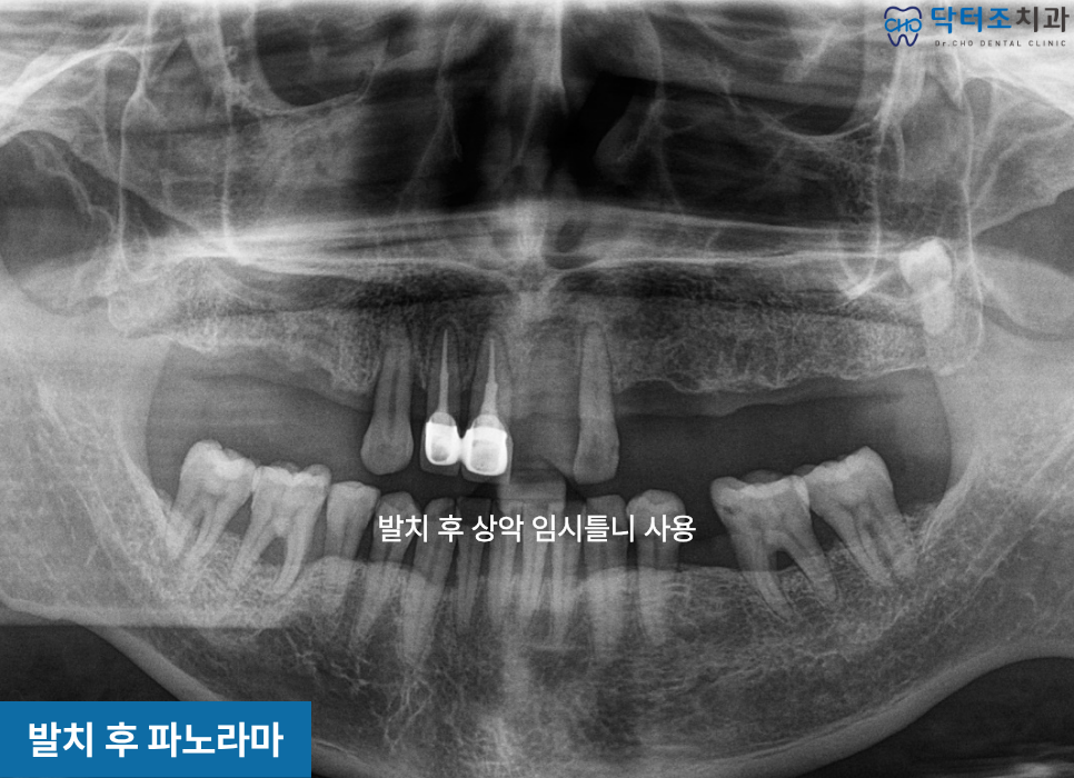 무치악임플란트하기전