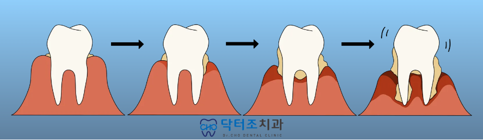 잇몸병진행과정