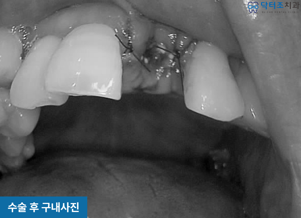 앞니임플란트