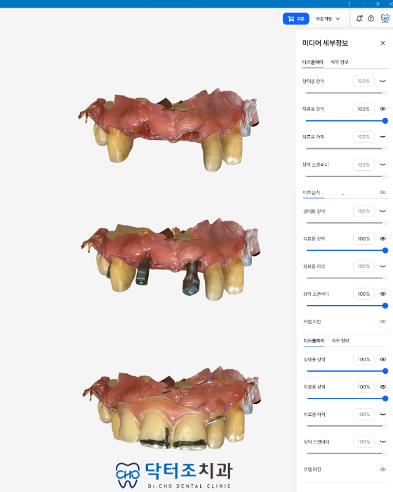 임플란트디자인