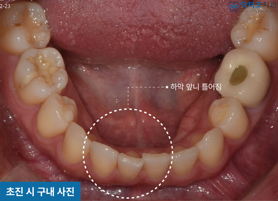 아랫니틀어짐 교정전
