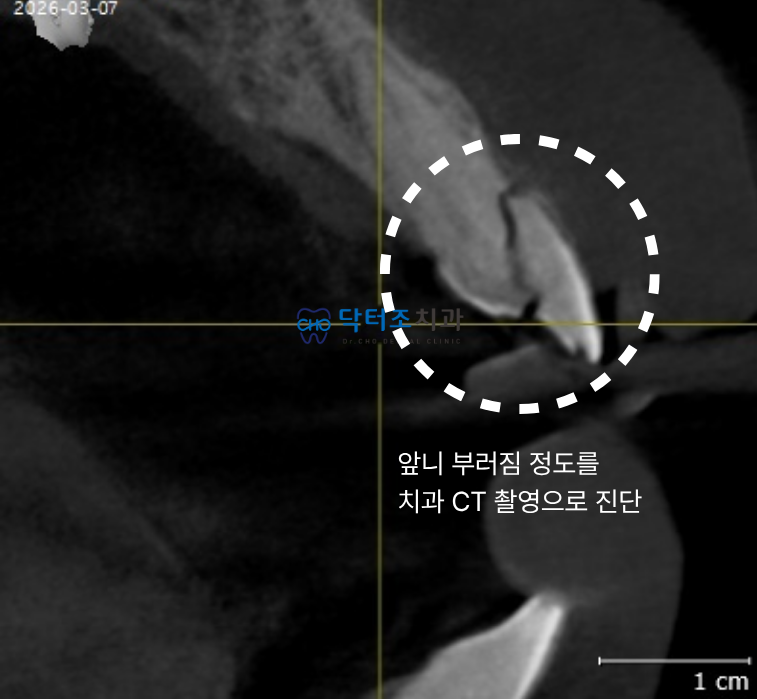 치과CT