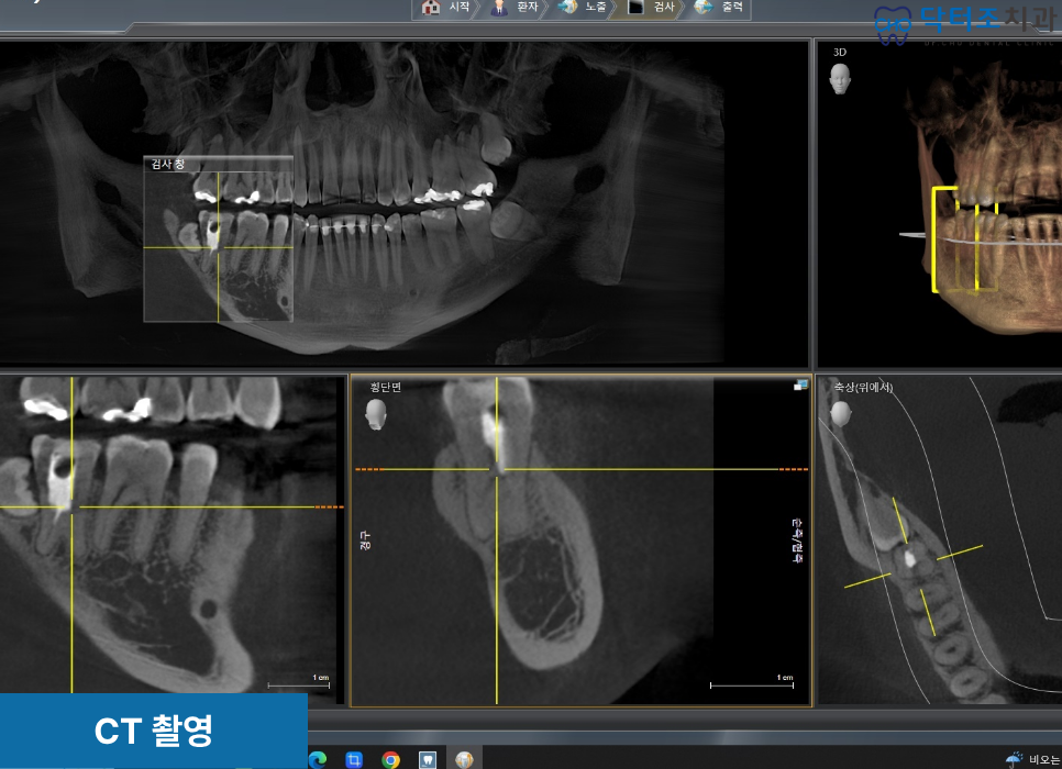 치아균열ct