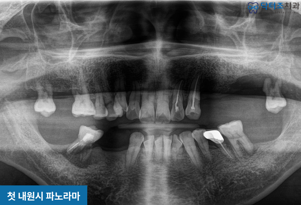 치아파절