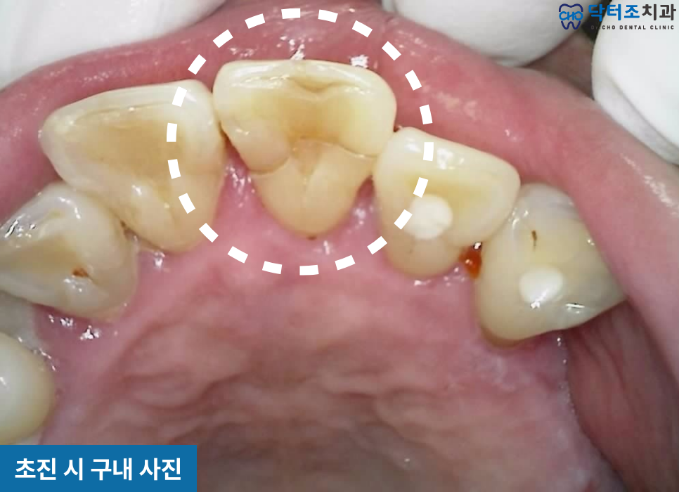 수직파절