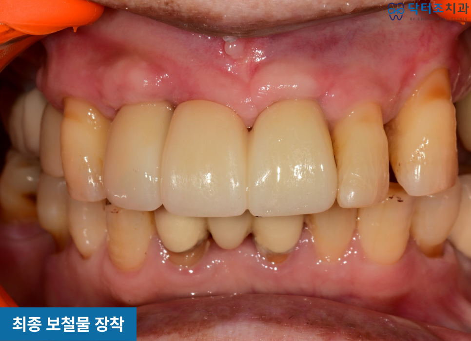 임플란트보철
